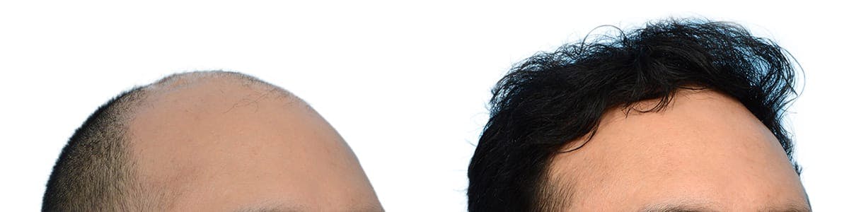 Hair Restoration Before & After Gallery - Patient 352209 - Image 3