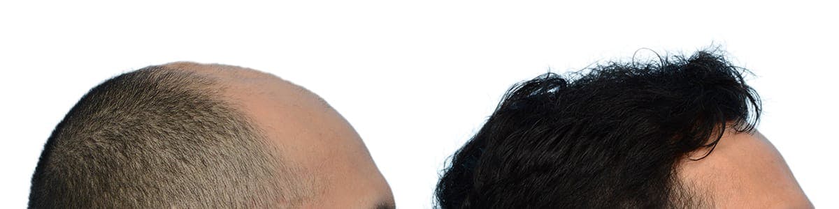 FUE Hair Transplant Before & After Gallery - Patient 737045 - Image 4