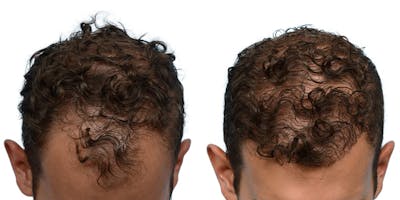 FUE Hair Transplant Before & After Gallery - Patient 414781 - Image 1