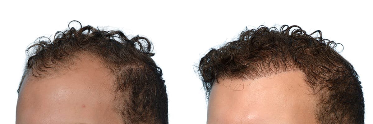 Hair Restoration Before & After Gallery - Patient 111148 - Image 2