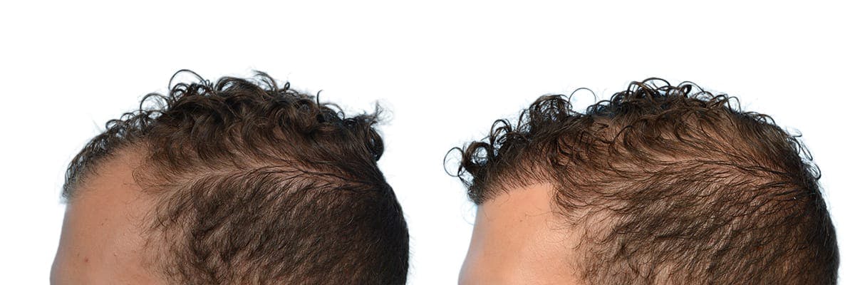 FUE Hair Transplant Before & After Gallery - Patient 414781 - Image 3