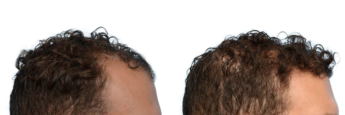 FUE Hair Transplant Before & After Gallery - Patient 414781 - Image 4
