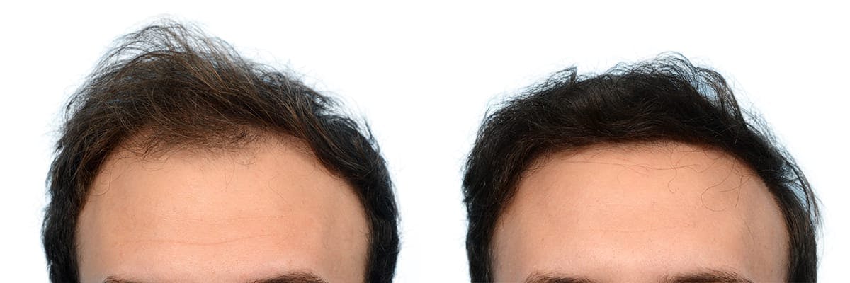 Platelet-Rich-Plasma Before & After Gallery - Patient 737909 - Image 1