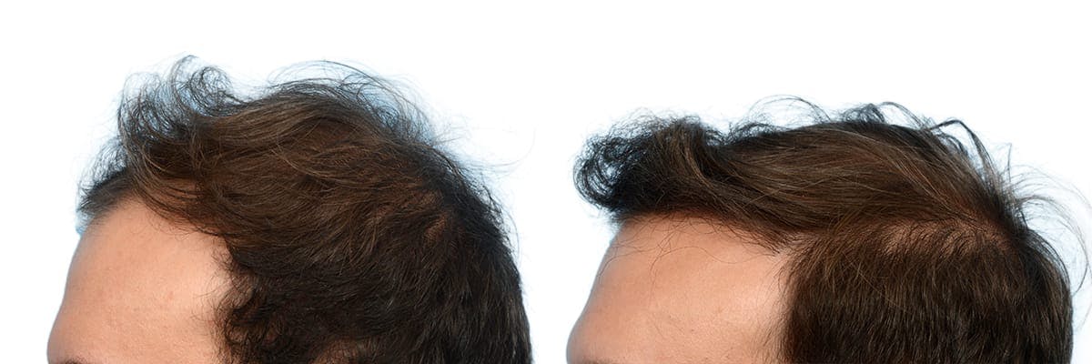 Hair Restoration Before & After Gallery - Patient 239174 - Image 2