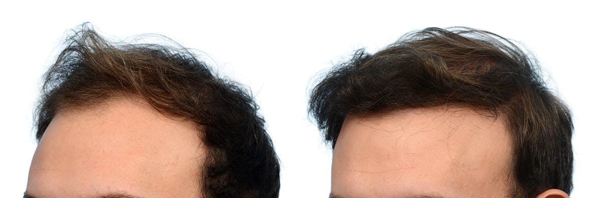 FUE Hair Transplant Before & After Gallery - Patient 338367 - Image 3