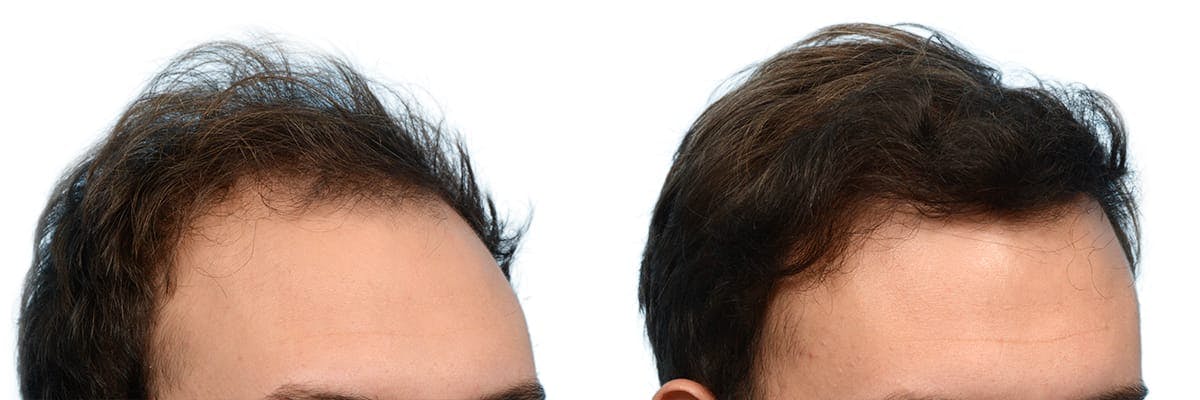 FUE Hair Transplant Before & After Gallery - Patient 338367 - Image 4
