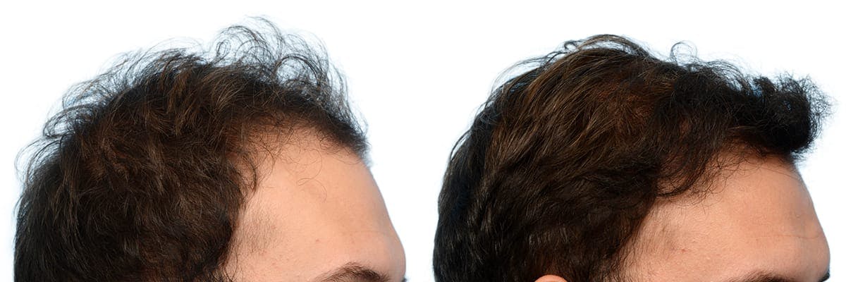 Hair Restoration Before & After Gallery - Patient 239174 - Image 5