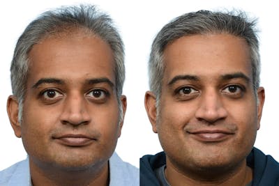 Hair Restoration Before & After Gallery - Patient 124924 - Image 1