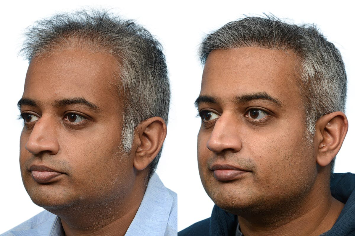 Hair Restoration Before & After Gallery - Patient 124924 - Image 2