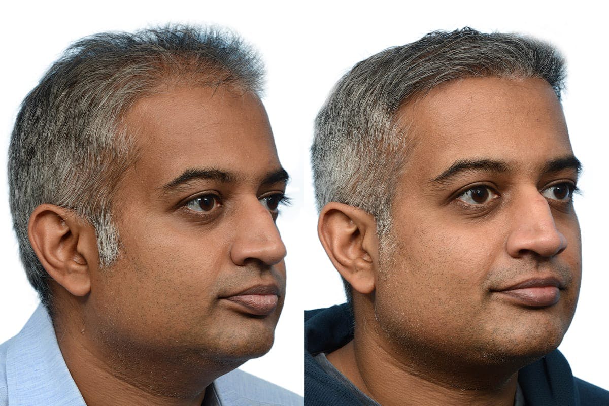 Hair Restoration Before & After Gallery - Patient 124924 - Image 3