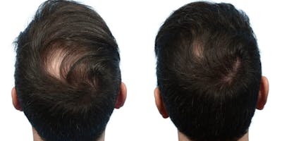 Hair Restoration Before & After Gallery - Patient 392186 - Image 1