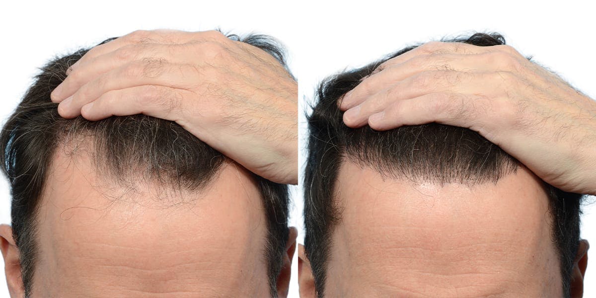 Hair Restoration Before & After Gallery - Patient 392186 - Image 2