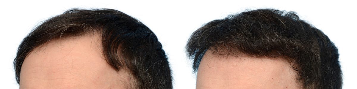 FUE Hair Transplant Before & After Gallery - Patient 960264 - Image 3
