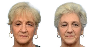 Female Hair Restoration Before & After Gallery - Patient 345347 - Image 1