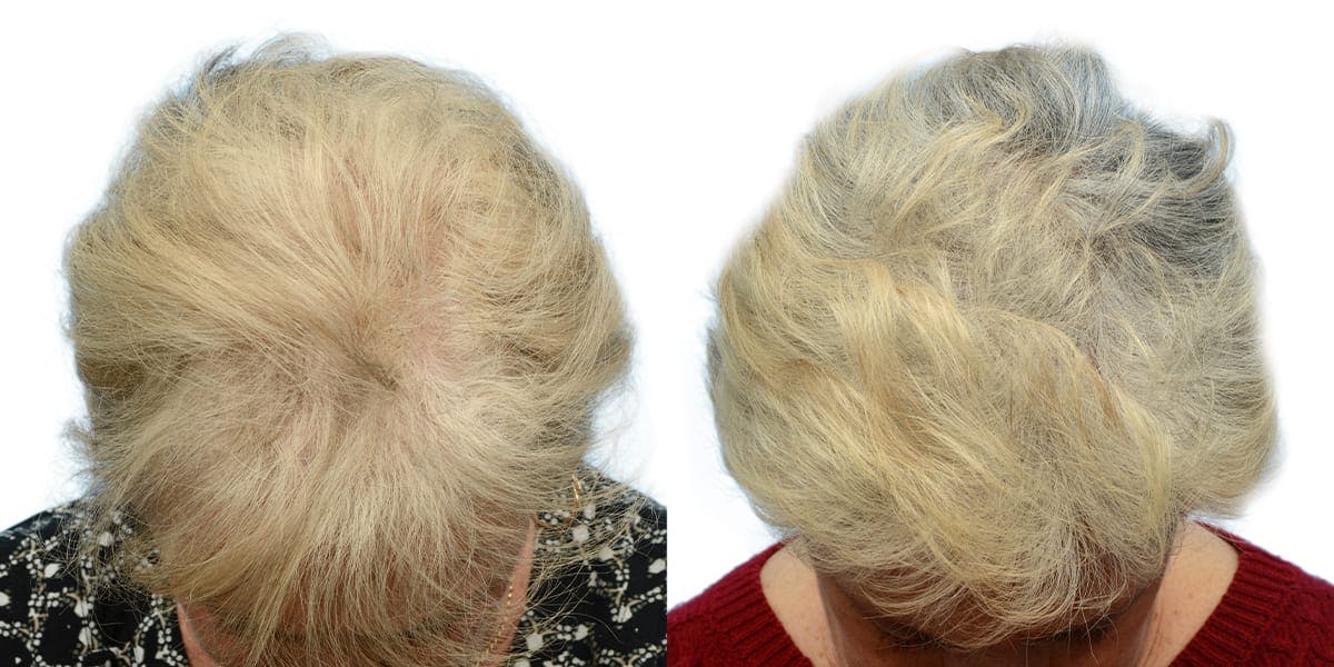 Female Hair Restoration Before & After Gallery - Patient 345347 - Image 2