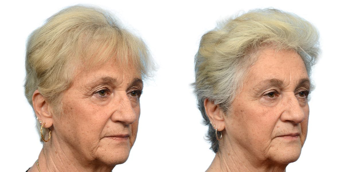 Hair Restoration Before & After Gallery - Patient 503140 - Image 3