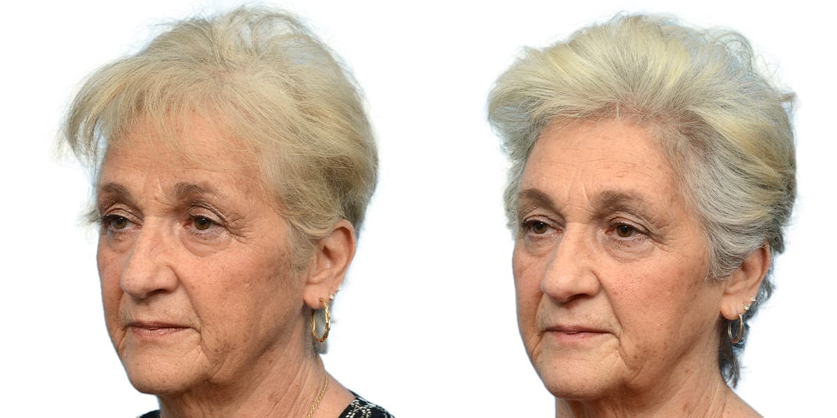 Platelet-Rich-Plasma Before & After Gallery - Patient 304946 - Image 4