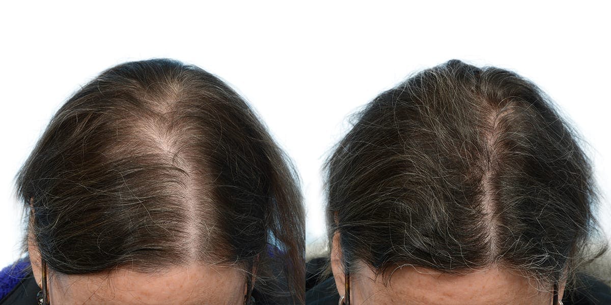 Female Hair Restoration Before & After Gallery - Patient 275099 - Image 1
