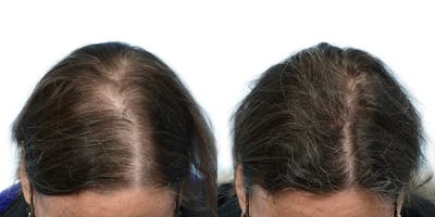 Hair Restoration Before & After Gallery - Patient 641093 - Image 1