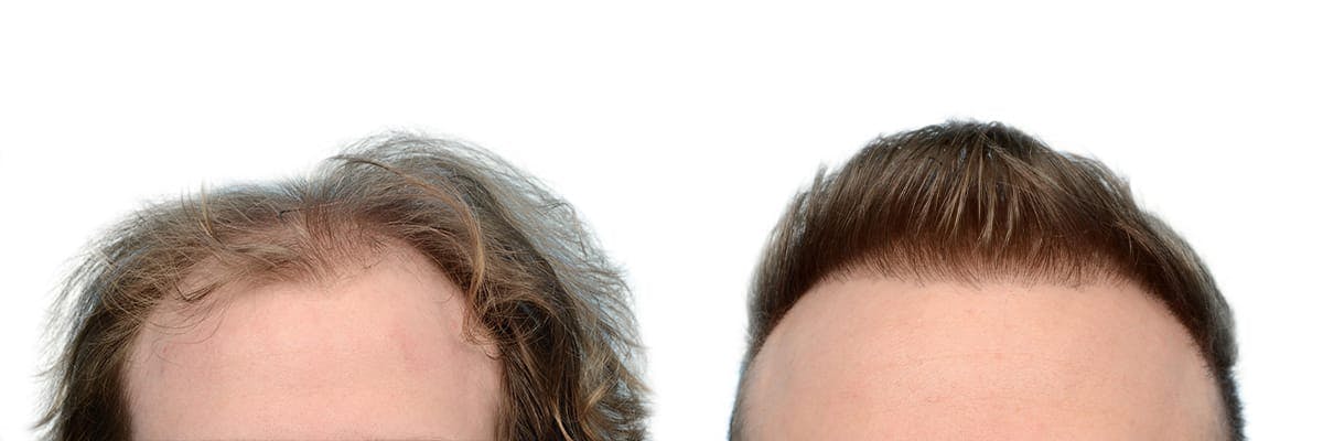 Hair Restoration Before & After Gallery - Patient 151957 - Image 3