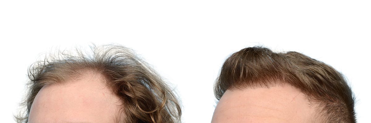 FUE Hair Transplant Before & After Gallery - Patient 239995 - Image 4