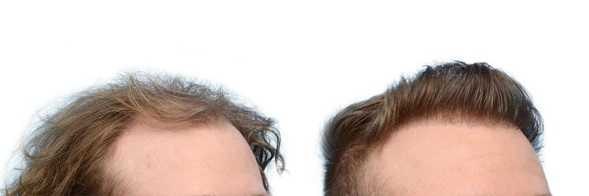 FUE Hair Transplant Before & After Gallery - Patient 239995 - Image 6