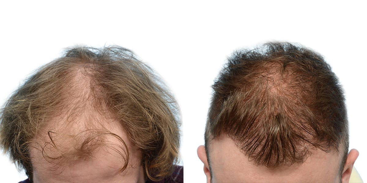 Hair Restoration Before & After Gallery - Patient 151957 - Image 2