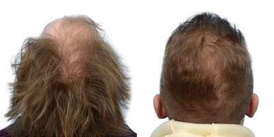 FUE Hair Transplant Before & After Gallery - Patient 239995 - Image 1