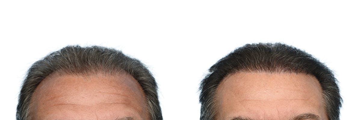 FUE Hair Transplant Before & After Gallery - Patient 116929 - Image 1