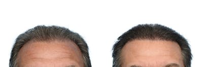 Hair Restoration Before & After Gallery - Patient 547156 - Image 1