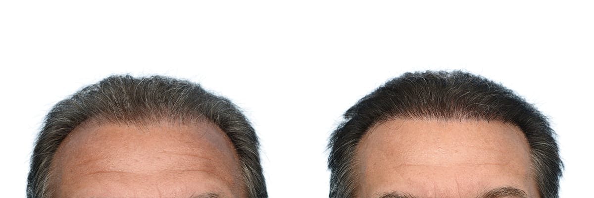 Hair Restoration Before & After Gallery - Patient 547156 - Image 1