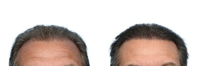 FUE Hair Transplant Before & After Gallery - Patient 116929 - Image 1