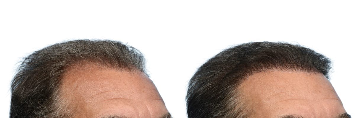 Hair Restoration Before & After Gallery - Patient 547156 - Image 2