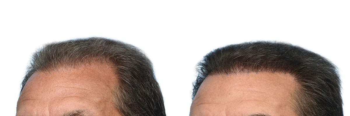 Hair Restoration Before & After Gallery - Patient 547156 - Image 3