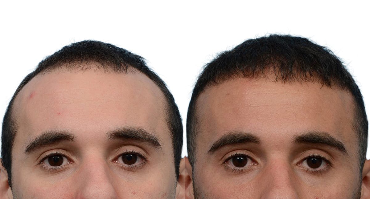 Hair Restoration Before & After Gallery - Patient 193011 - Image 2
