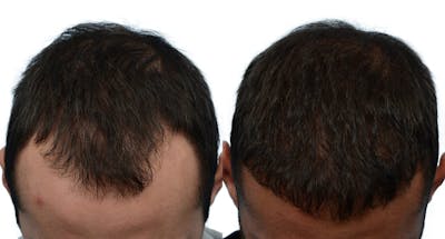 Hair Restoration Before & After Gallery - Patient 193011 - Image 1