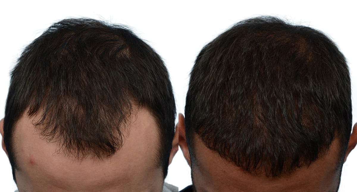Hair Restoration Before & After Gallery - Patient 193011 - Image 1