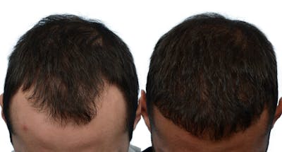 Platelet-Rich-Plasma Before & After Gallery - Patient 414592 - Image 1