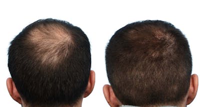FUE Hair Transplant Before & After Gallery - Patient 568039 - Image 1