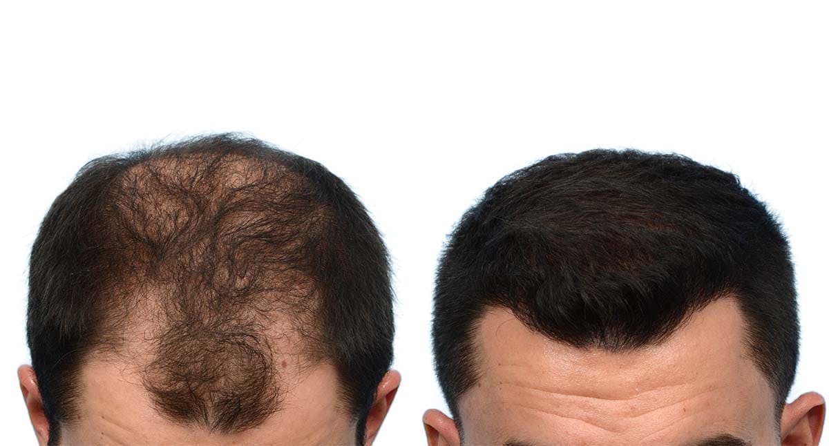 Hair Restoration Before & After Gallery - Patient 270337 - Image 2