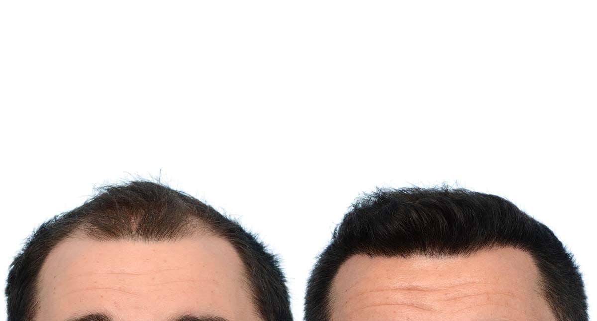 Hair Restoration Before & After Gallery - Patient 270337 - Image 3
