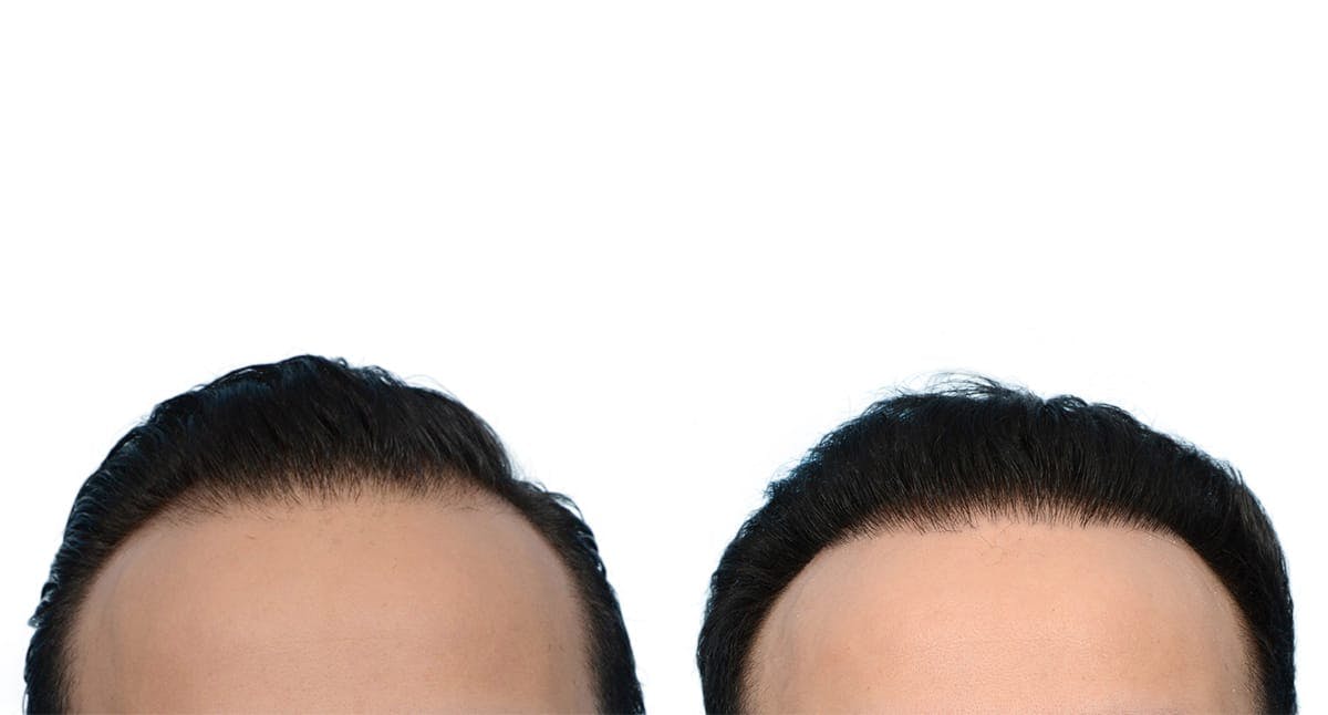 Hair Restoration Before & After Gallery - Patient 388464 - Image 2