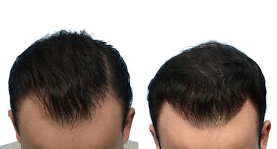 Hair Restoration Before & After Gallery - Patient 388464 - Image 1