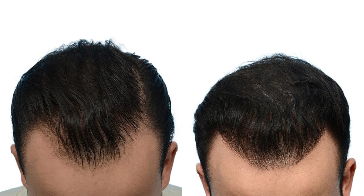 Hair Restoration Before & After Gallery - Patient 388464 - Image 1