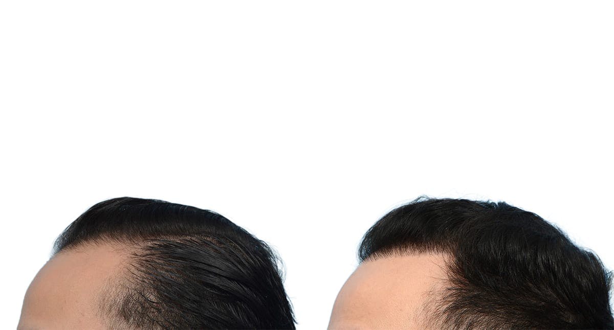 Hair Restoration Before & After Gallery - Patient 388464 - Image 3