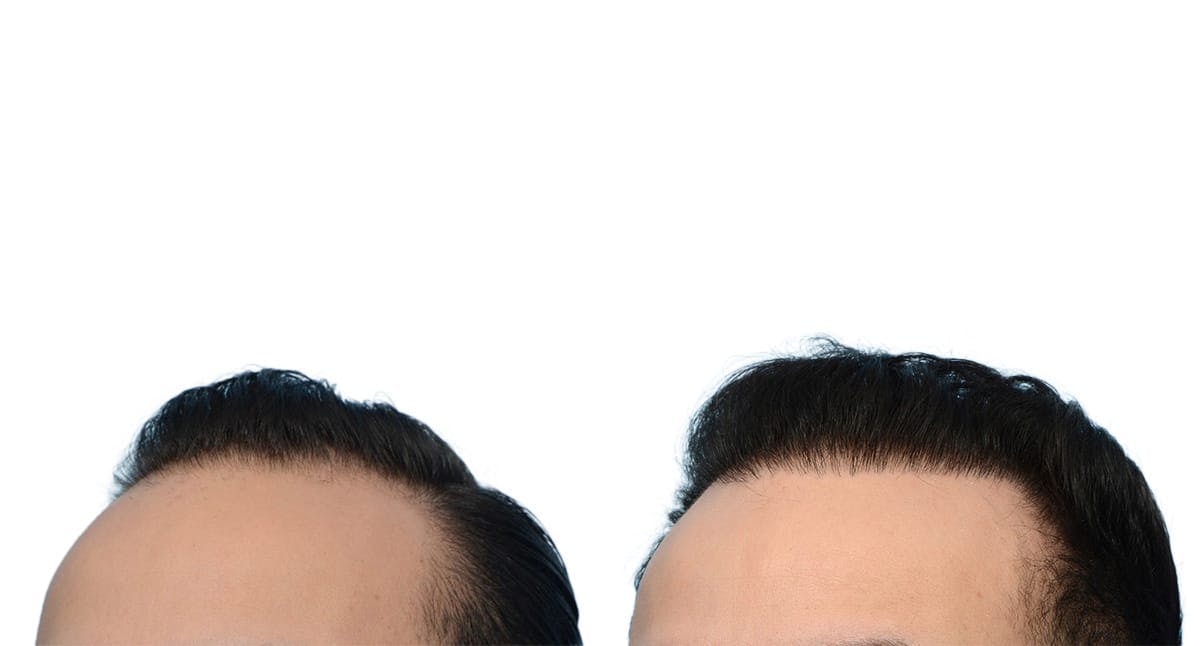 FUE Hair Transplant Before & After Gallery - Patient 348651 - Image 4