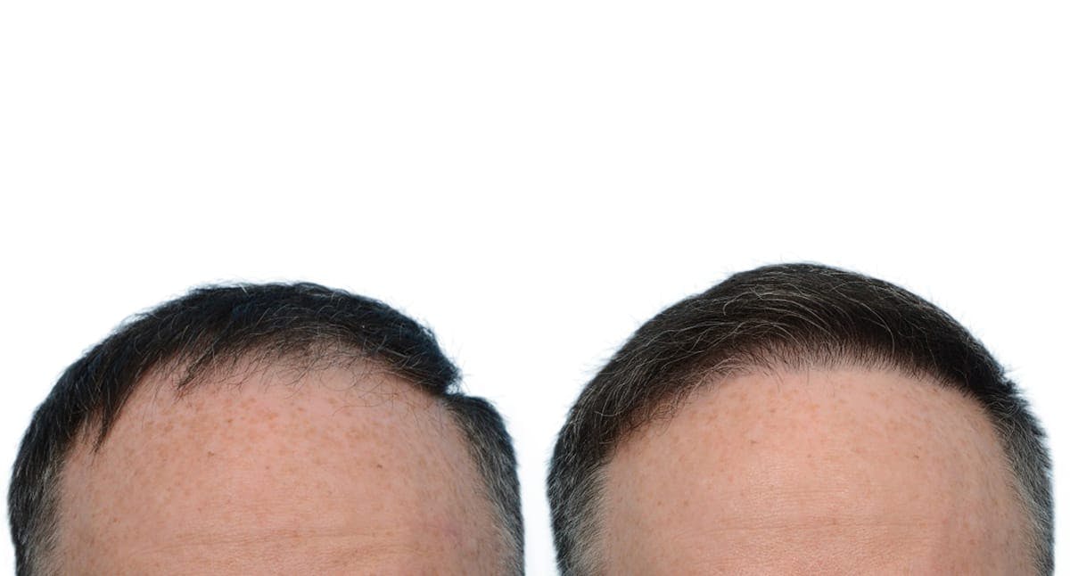 Hair Restoration Before & After Gallery - Patient 366613 - Image 2