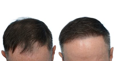 FUE Hair Transplant Before & After Gallery - Patient 331024 - Image 1