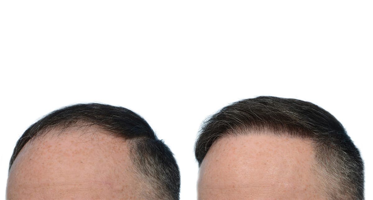Hair Restoration Before & After Gallery - Patient 366613 - Image 3