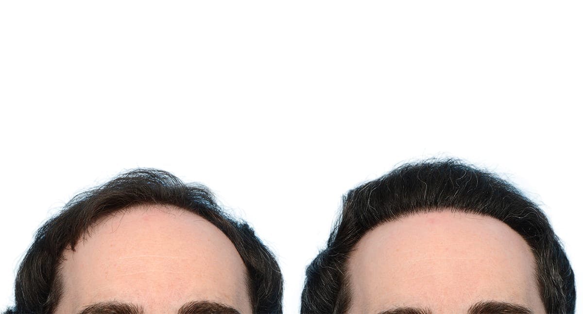 Hair Restoration Before & After Gallery - Patient 373918 - Image 2
